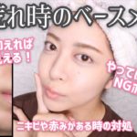 【最新版】肌荒れした時のベースメイク方法！ニキビが出来てても綺麗に仕上がる✨注意点やポイントも！【プチプラ/デパコス/ナチュラルコスメ】