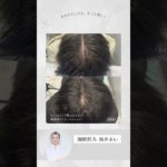 頭皮アートメイクで、気になる分け目の割れをナチュラルに解消✨#分け目の悩み #頭皮アートメイク #生え際ケア #薄毛対策